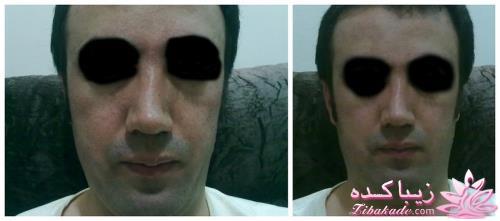 عمل زیبایی بینی برای بار دوم + عکس